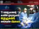 11 വയസ്സുകാരന്റെ കാലിൽ ഇരുമ്പുകമ്പി തുളച്ചുകയറി; ശസ്ത്രക്രിയ വിജയകരം